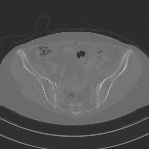 April fools' 2019- calcified peritoneal arachnoidosis (Radiopaedia 67273-76636 Axial bone window 41).png