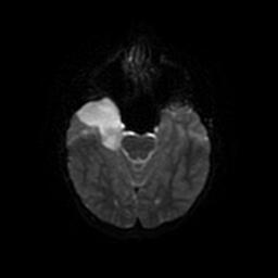 Arachnoid cyst - middle cranial fossa (Radiopaedia 67671-77088 Axial DWI 36).jpg