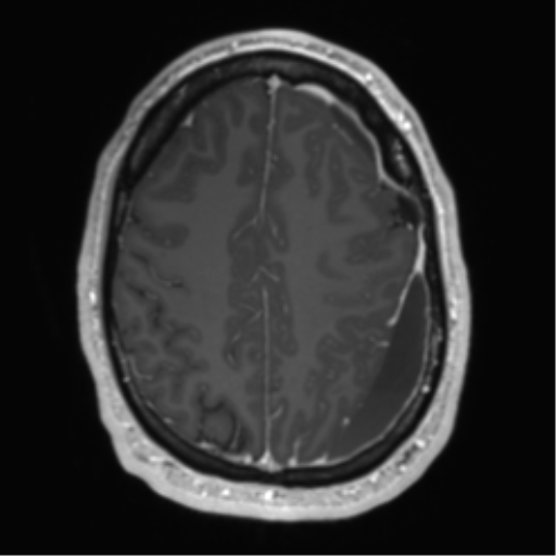 Arachnoid cyst with subdural hematoma (Radiopaedia 85892-101743 Axial T1 C+ 63).png