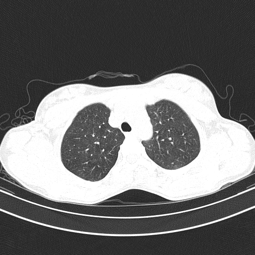 File:Arteria lusoria (Radiopaedia 88528-105192 Axial lung window 18).jpg