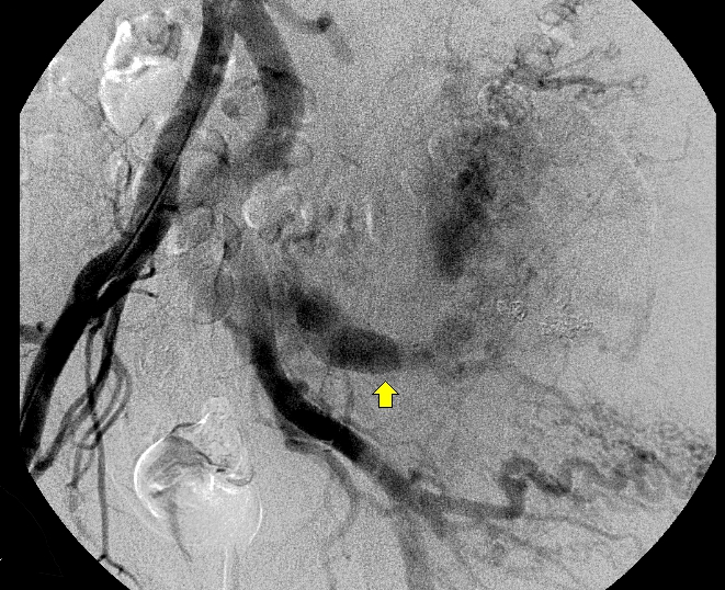 File:Arteriovenous malformation of the gluteus (Radiopaedia 8467-9291 Frontal Iliac artery 1).jpg