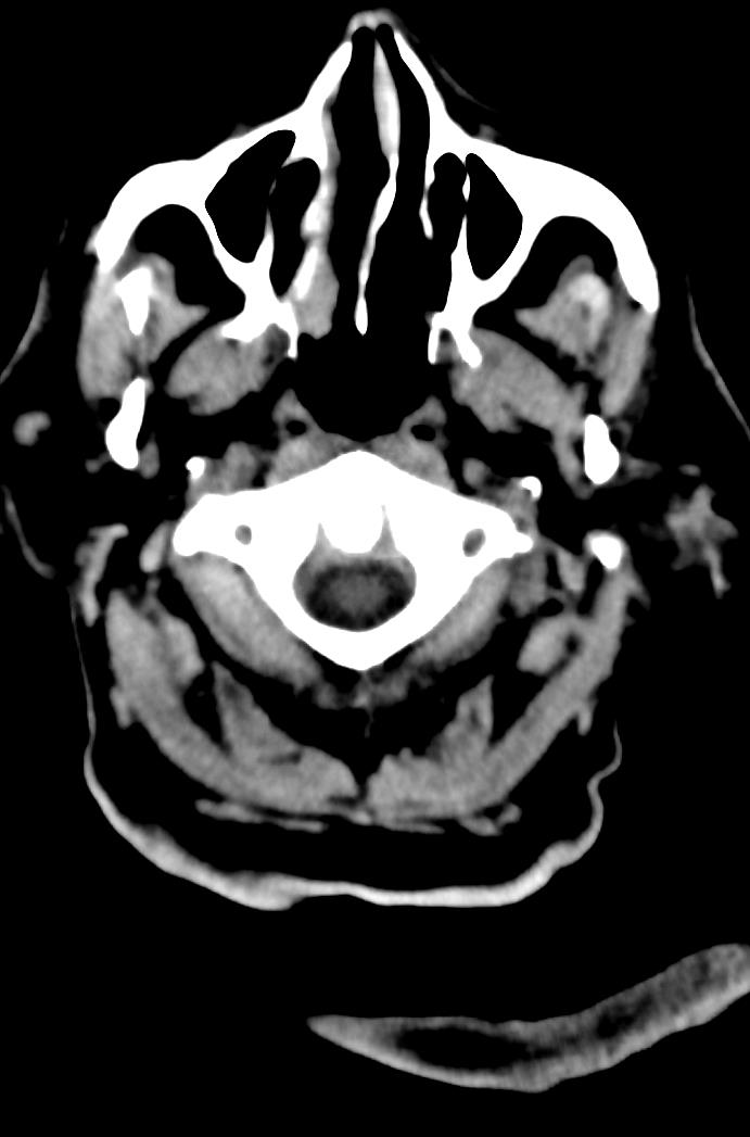 Artery of Percheron infarction (Radiopaedia 80613-94202 Axial non-contrast 10).jpg