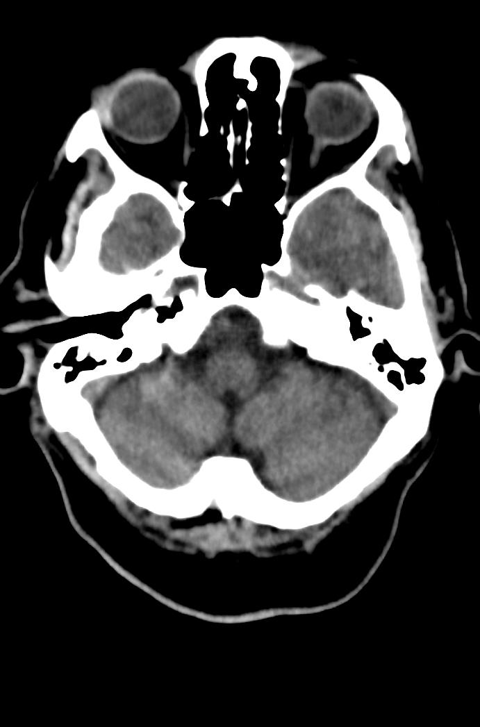 Artery of Percheron infarction (Radiopaedia 80613-94202 Axial non-contrast 46).jpg