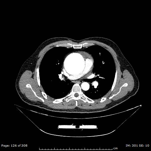 File:Ascending aortic aneurysm (Radiopaedia 50086-55404 A 32).jpg