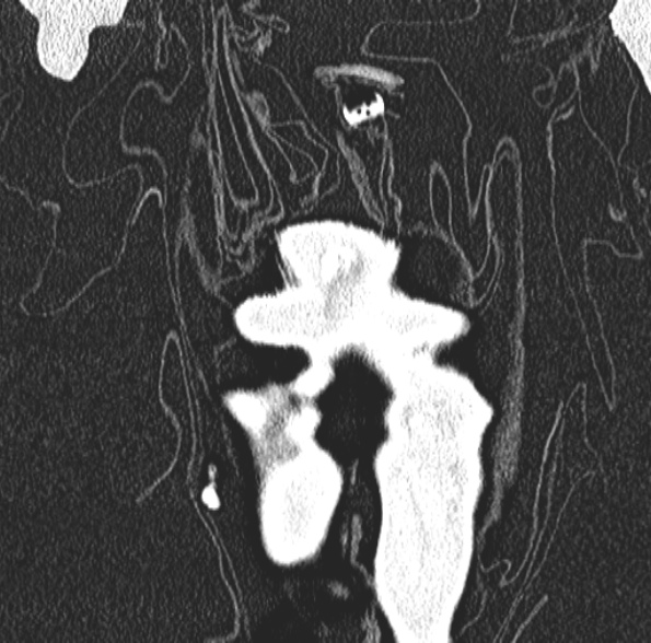 Aspergilloma- with Monod sign (Radiopaedia 44737-48532 Coronal lung window 104).jpg