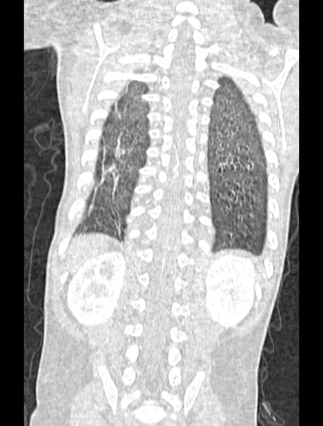 Asplenia syndrome (Radiopaedia 73083-83792 Coronal lung window 116).jpg
