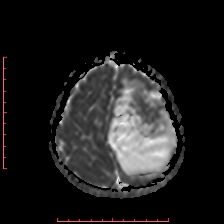 Astroblastoma (Radiopaedia 74287-85162 Axial ADC 57).jpg