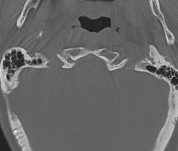 Atlanto-axial subluxation (Radiopaedia 36610-38176 Axial bone window 8).png