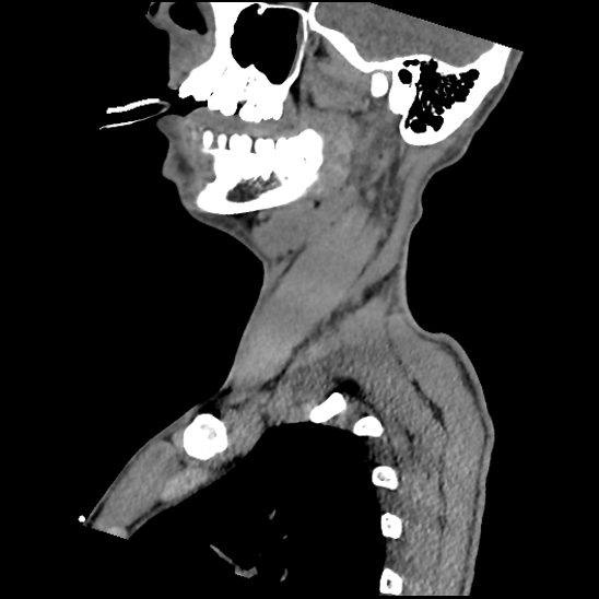File:Atlanto-occipital dissociation (Traynelis type 1), C2 teardrop fracture, C6-7 facet joint dislocation (Radiopaedia 87655-104061 D 21).jpg