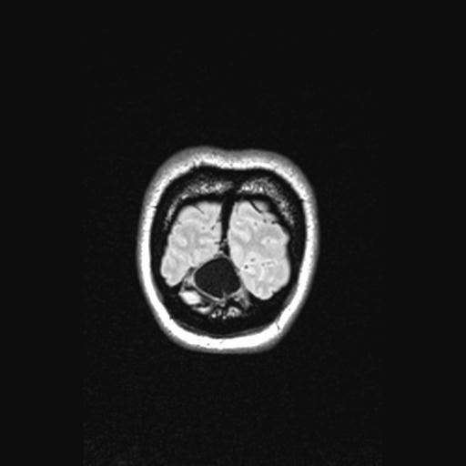 Atretic encephalocoele with inferior vermis hypoplasia (Radiopaedia 30443-31108 Coronal FLAIR 20).jpg