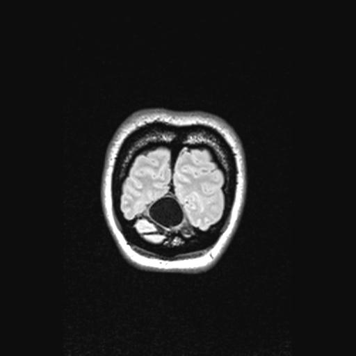 File:Atretic encephalocoele with inferior vermis hypoplasia (Radiopaedia 30443-31108 Coronal FLAIR 22).jpg