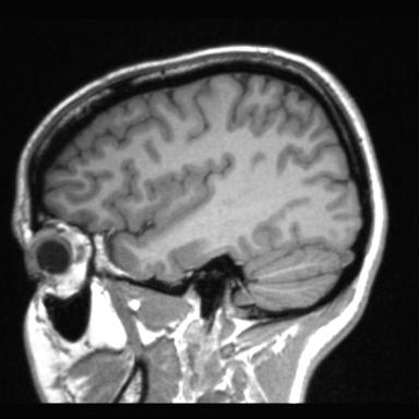 Atretic encephalocoele with inferior vermis hypoplasia (Radiopaedia 30443-31108 Sagittal T1 102).jpg
