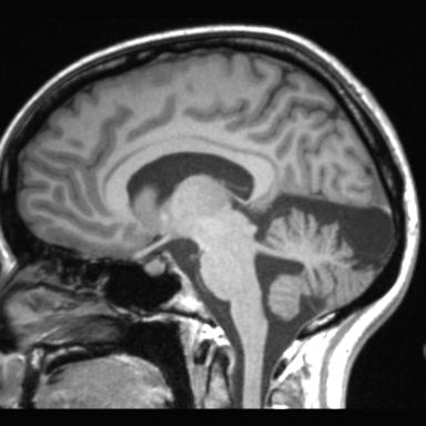 File:Atretic encephalocoele with inferior vermis hypoplasia (Radiopaedia 30443-31108 Sagittal T1 71).jpg