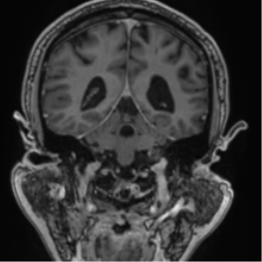 Atypical meningioma (WHO grade II) with brain invasion (Radiopaedia 57767-64729 Coronal T1 C+ 55).png
