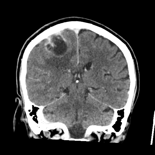Atypical meningioma (WHO grade II) with osseous invasion (Radiopaedia 53654-59715 Coronal C+ delayed 38).png