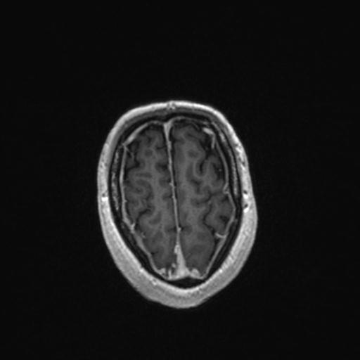 Atypical meningioma (grade II) - en plaque (Radiopaedia 29633-30147 Axial T1 C+ 157).jpg