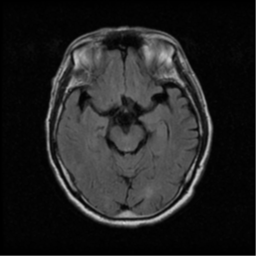 File:Atypical meningioma with skull invasion (Radiopaedia 34357-35648 Axial FLAIR 9).png