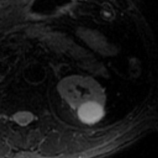File:Atypical renal cyst on MRI (Radiopaedia 17349-17046 Axial T2 fat sat 6).jpg