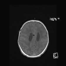 File:Atypical teratoid rhabdoid tumor (prenatal US and neonatal MRI) (Radiopaedia 59091-66388 Axial T1 43).jpg