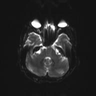 Autoimmune limbic encephalitis (Radiopaedia 30363-31005 Axial B0 and DWI 10).jpg