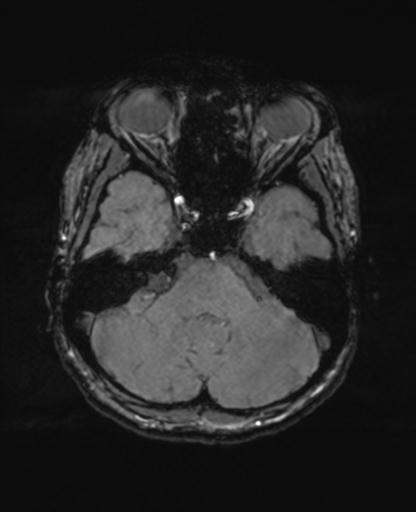 Autoimmune limbic encephalitis (Radiopaedia 30363-31005 SWI - magnitude 19).jpg