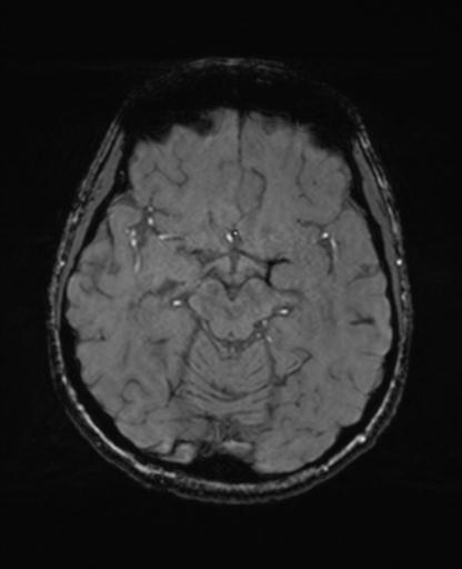 Autoimmune limbic encephalitis (Radiopaedia 30363-31005 SWI - magnitude 31).jpg
