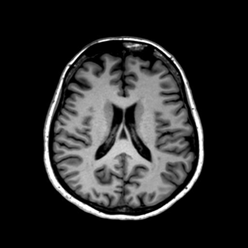 Autoimmune limbic encephalitis (Radiopaedia 30363-31005 T1 Axial 1mm 92).jpg