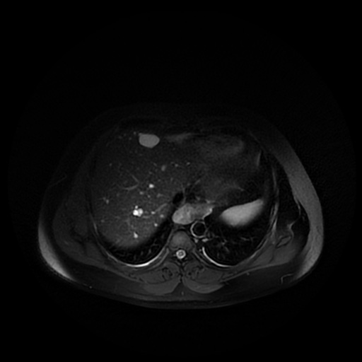 File:Autosomal dominant polycystic kidney disease (Radiopaedia 50259-55611 Axial T2 fat sat 5).jpg
