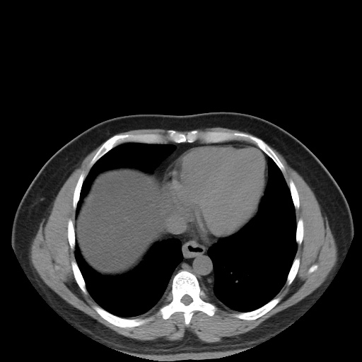 Autosomal dominant polycystic kidney disease (Radiopaedia 50259-55612 Axial non-contrast 11).jpg