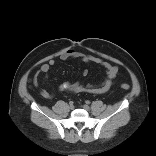 Autosomal dominant polycystic kidney disease (Radiopaedia 50259-55612 Axial non-contrast 61).jpg