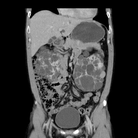 Autosomal dominant polycystic kidney disease (Radiopaedia 66349-75582 A 22).jpg