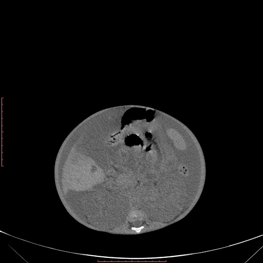 Autosomal recessive polycystic kidney disease associated with Caroli disease (Radiopaedia 61932-69984 B 205).jpg