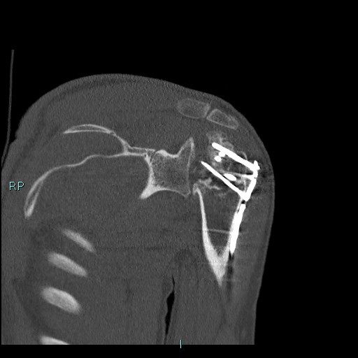 Avascular necrosis after fracture dislocations of the proximal humerus (Radiopaedia 88078-104655 Coronal bone window 75).jpg