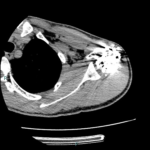 Avascular necrosis after fracture dislocations of the proximal humerus (Radiopaedia 88078-104655 D 50).jpg