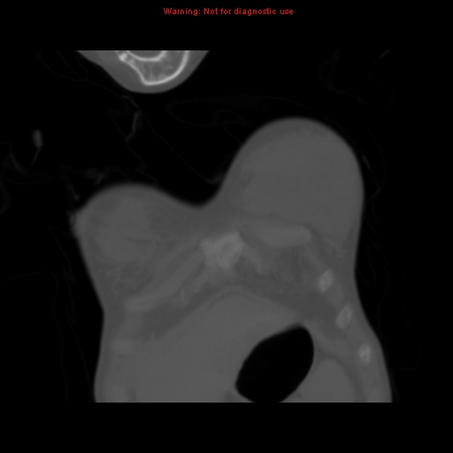 File:Avascular necrosis in sickle cell disease (Radiopaedia 17448-17152 Coronal bone window 10).jpg
