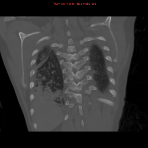 Avascular necrosis in sickle cell disease (Radiopaedia 17448-17152 Coronal bone window 106).jpg