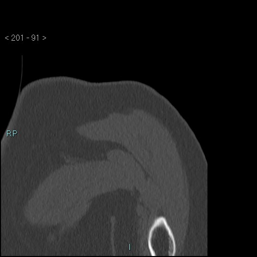 Avascular necrosis of the shoulder - Cruess stage I (Radiopaedia 77674-89887 Coronal bone window 90).jpg