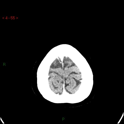 Azygos anterior cerebral artery (Radiopaedia 51987-57833 A 55).jpg