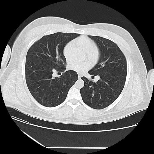 Azygos fissure (Radiopaedia 88181-104784 Axial lung window 27).jpg
