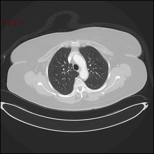 Azygos fissure and lobe (Radiopaedia 47620-52278 Axial lung window 27).jpg