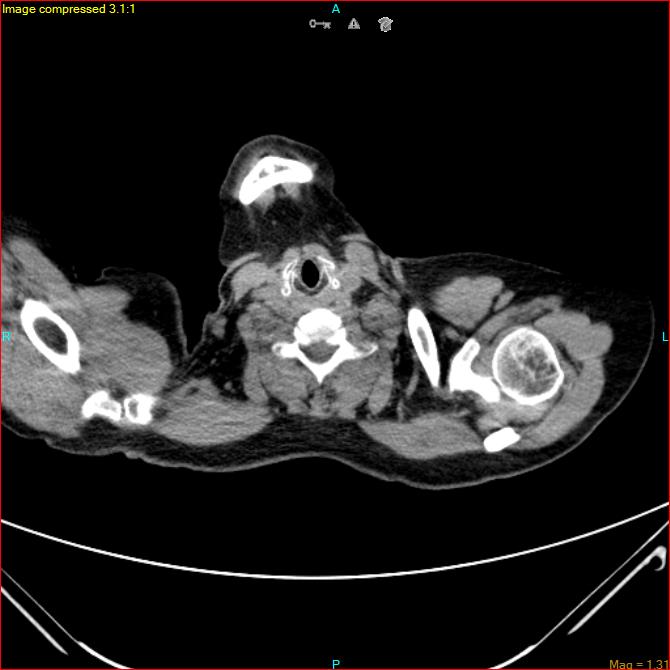 Azygos vein aneurysm (Radiopaedia 77824-90130 A 2).jpg