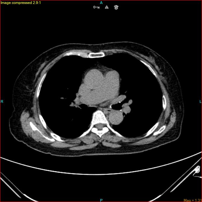Azygos vein aneurysm (Radiopaedia 77824-90130 A 30).jpg