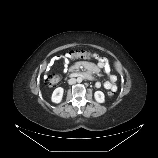 File:B-cell lymphoma of the mesentery (Radiopaedia 65711-74827 Axial 11).jpg