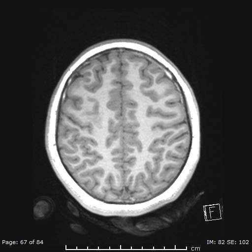 Balo concentric sclerosis (Radiopaedia 61637-69636 Axial T1 67).jpg