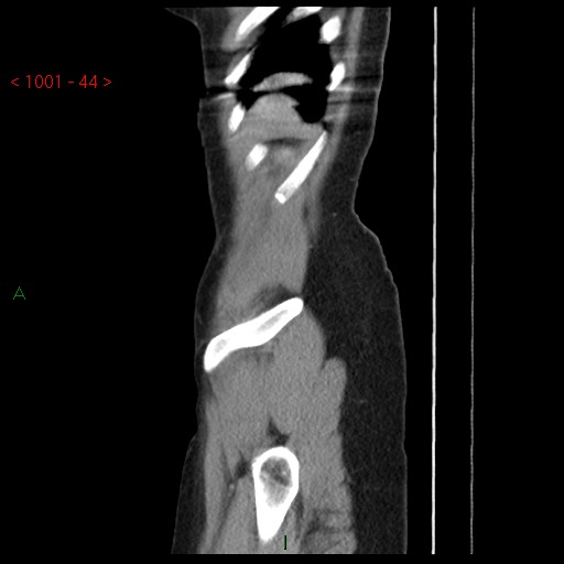 File:Bartholin gland cyst (Radiopaedia 54904-61181 Sagittal C+ delayed 44).jpg