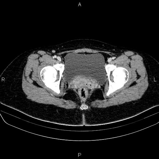 File:Bartholin gland cyst (Radiopaedia 62635-70930 Axial Post contrast 67).jpg