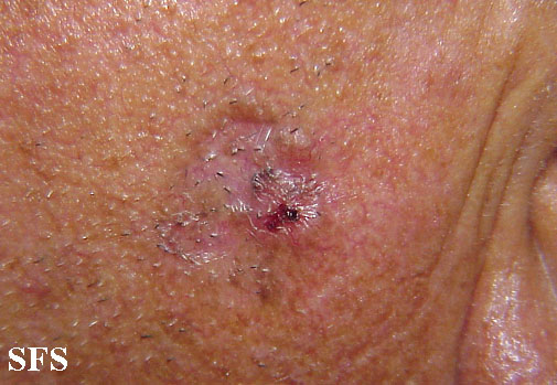 Basal Cell Carcinoma (Dermatology Atlas 41).jpg
