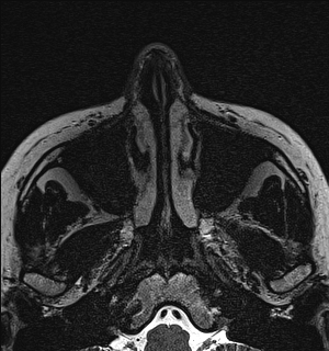 File:Basal cell carcinoma - nasal region (Radiopaedia 70292-80365 Axial Gradient Echo 10).jpg