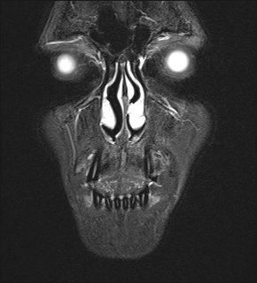 File:Basal cell carcinoma - nasal region (Radiopaedia 70292-80365 Coronal STIR 8).jpg