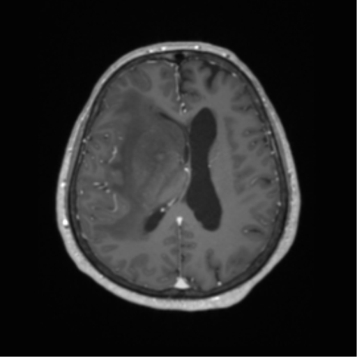 Basal ganglia metastasis (Radiopaedia 78928-91828 Axial T1 C+ 45).png